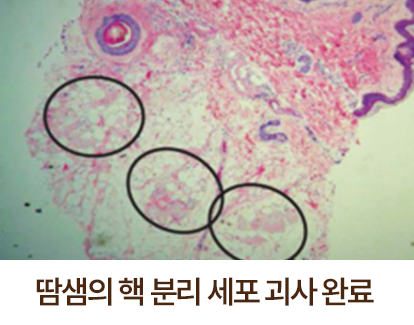땀샘의 핵 분리 세포 괴사 완료