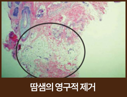땀샘의 영구적 제거